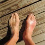 types of arthritis